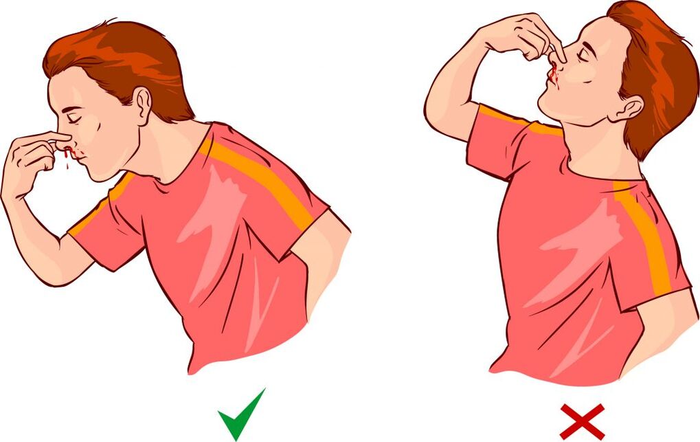 A magas vérnyomás epistaxis