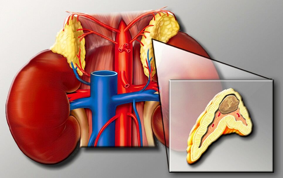 Feochromocytoma magas vérnyomáshoz
